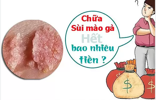 Chi phí chữa bệnh sùi mào gà bao nhiêu tiền? Bảng giá mới