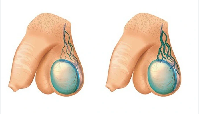 Nguyên nhân giãn tĩnh mạch tinh hoàn và cách chữa trị