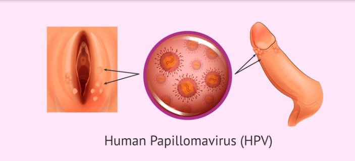 HPV là gì? Có bao nhiêu chủng, dấu hiệu nhận biết